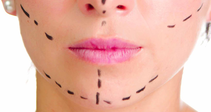 Closeup headshot caucasian woman with dotted lines drawn around face looking into camera, preparing cosmetic surgery