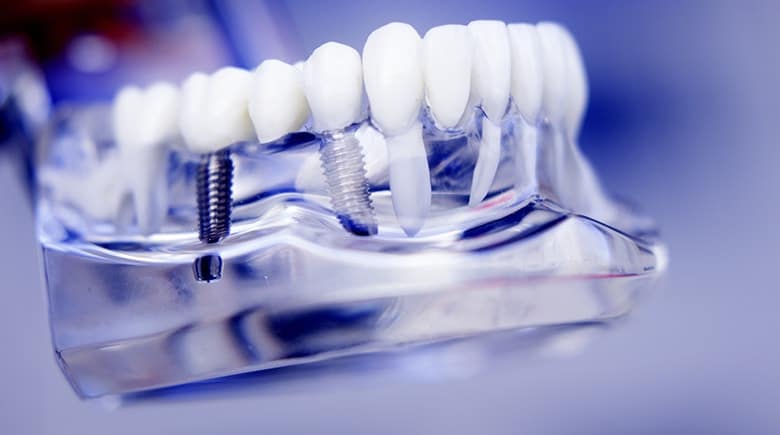 Why Insurance Won't Cover Dental Implants | Hilton Head
