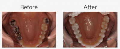 Why Not Keep Metal Fillings?