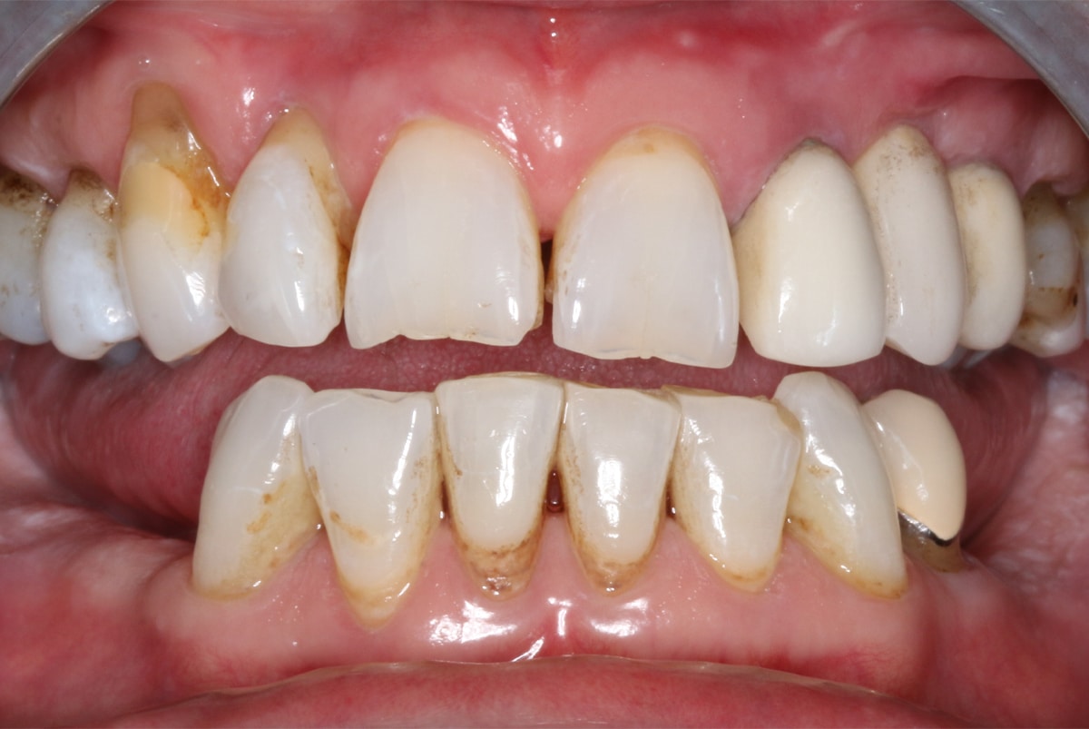 before cosmetic dental work completed by Beyond Exceptional Dentistry