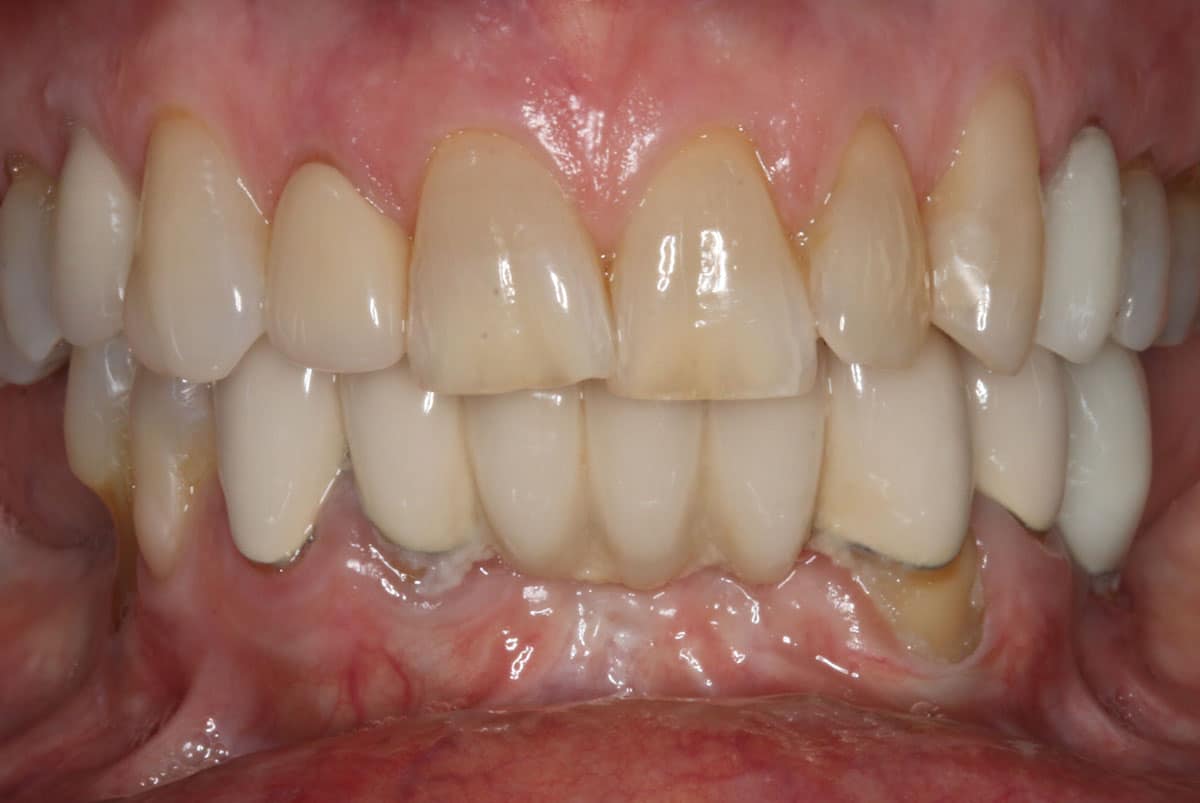 before a cosmetic dental procedure by Beyond Exceptional Dentistry closeup