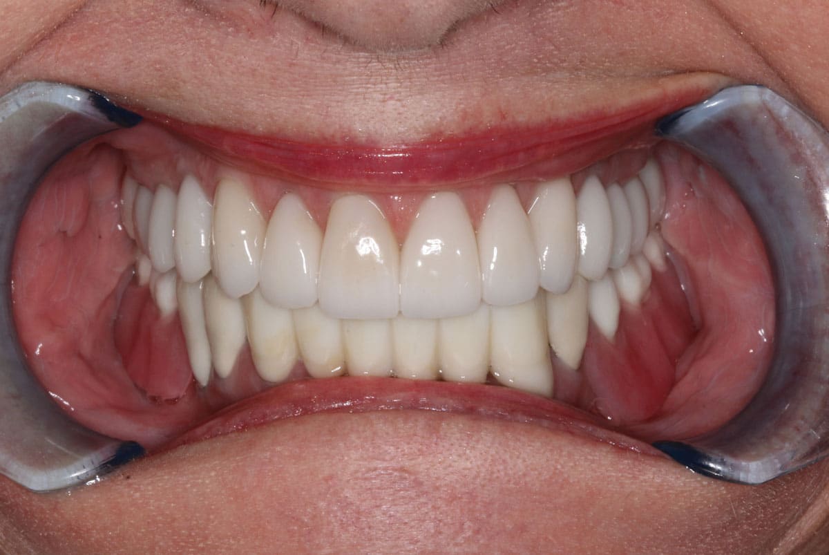 After a cosmetic dental procedure by Beyond Exceptional Dentistry closeup