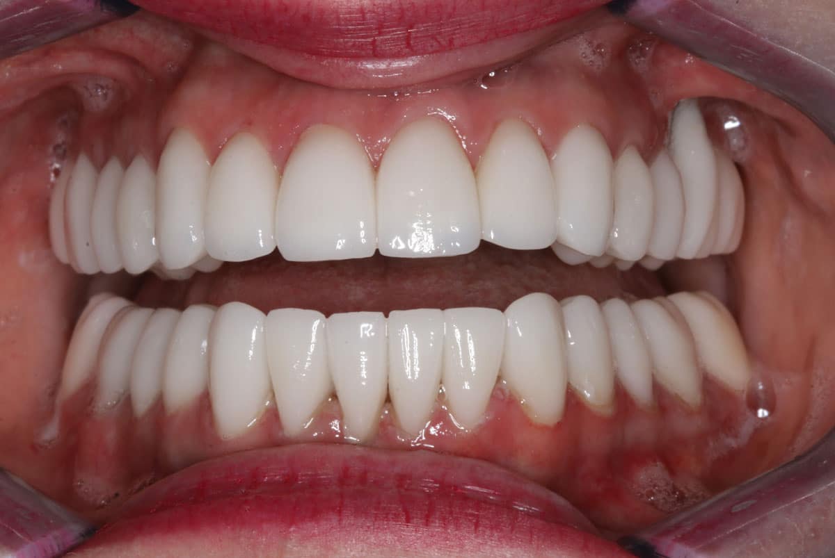 After a cosmetic dental procedure by Beyond Exceptional Dentistry closeup