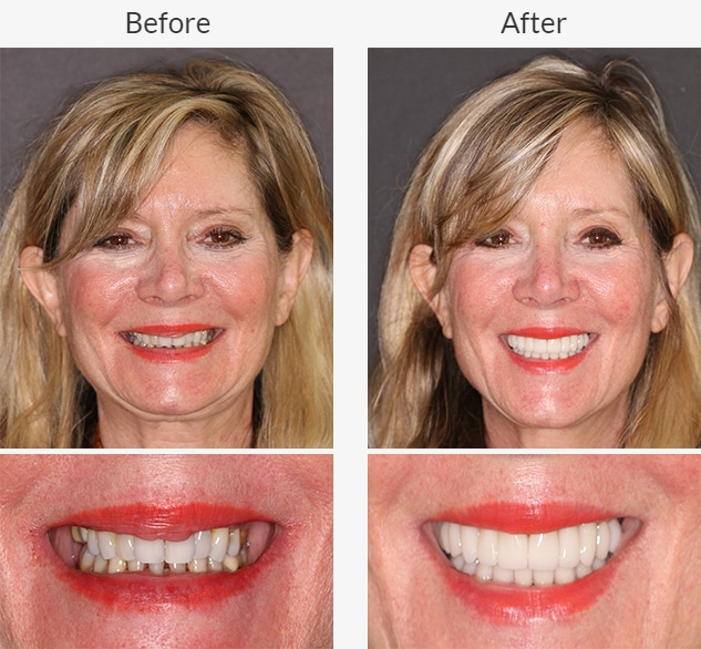 Female dental patient shows off the before and after treatment smiles from Beyond Exceptional Dentistry